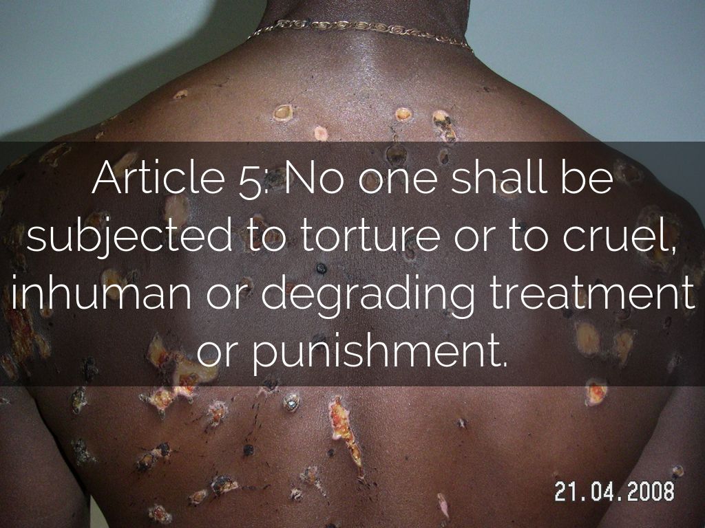 Article 5-No one shall be subjected to torture or to cruel, Inhuman or degrading treatment or punishment.